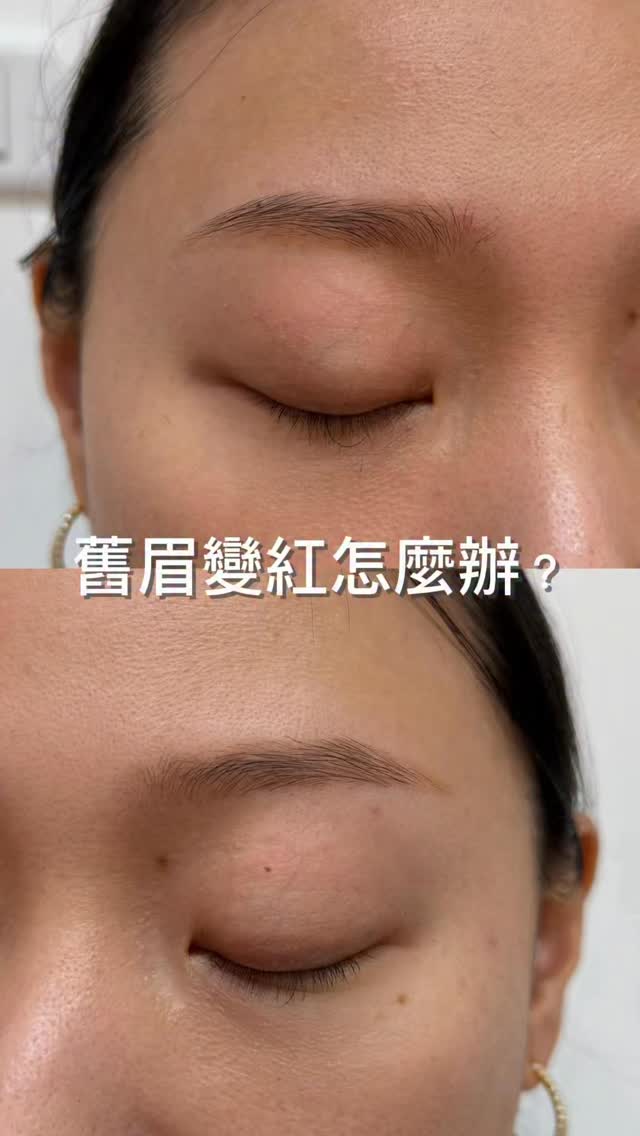 很多人以為舊眉變橘、變紅，
只要直接補色蓋掉就好了。

但其實不是每一組舊眉
都能直接蓋色。

她的舊眉橘色殘留明顯，
所以先進行兩次除色淡化，
改善底色後，再重新設計適合她的眉型。

這次也一起調整了左右高低差，
讓整體看起來更乾淨、自然，也更有精神✨

如果你也有舊眉困擾，
不知道該除色還是重做，
都可以私訊問我🩵

#舊眉重做 #除色 #台北霧眉 #霧眉 #忠孝復興霧眉 縮圖