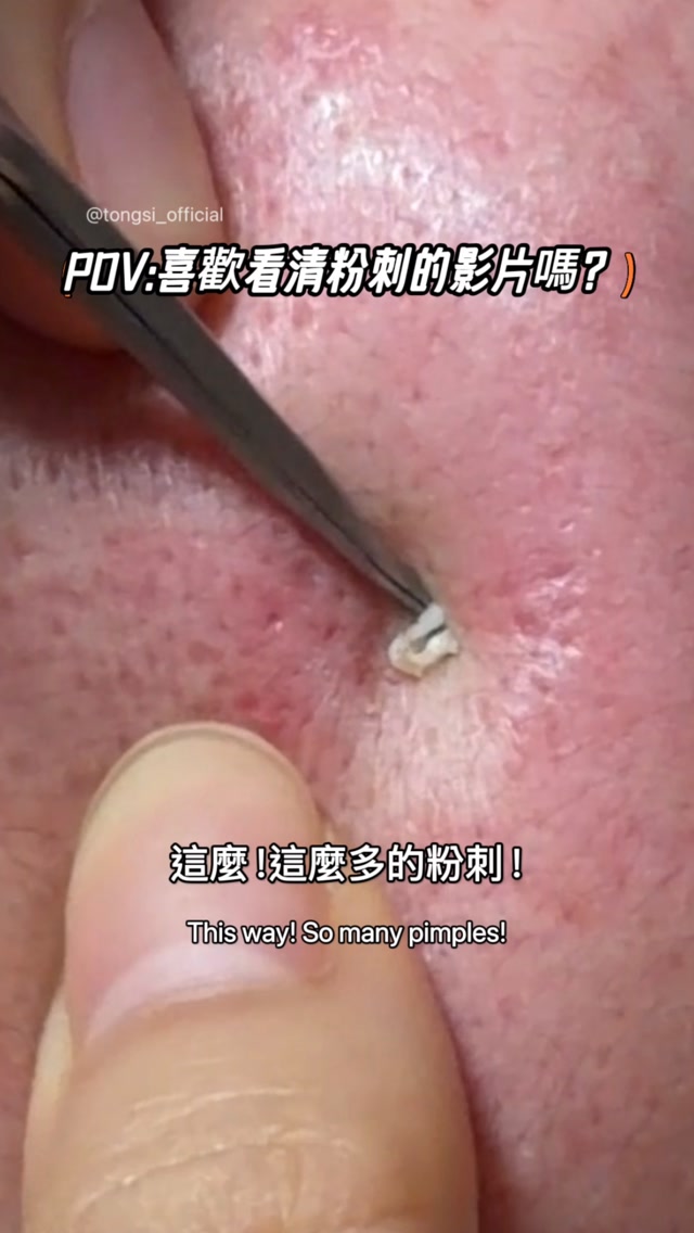 今天是 來自療癒系の同學🧑🏻🎓
P.s 清粉刺會痛 想改善膚況 請尊重專業! 縮圖