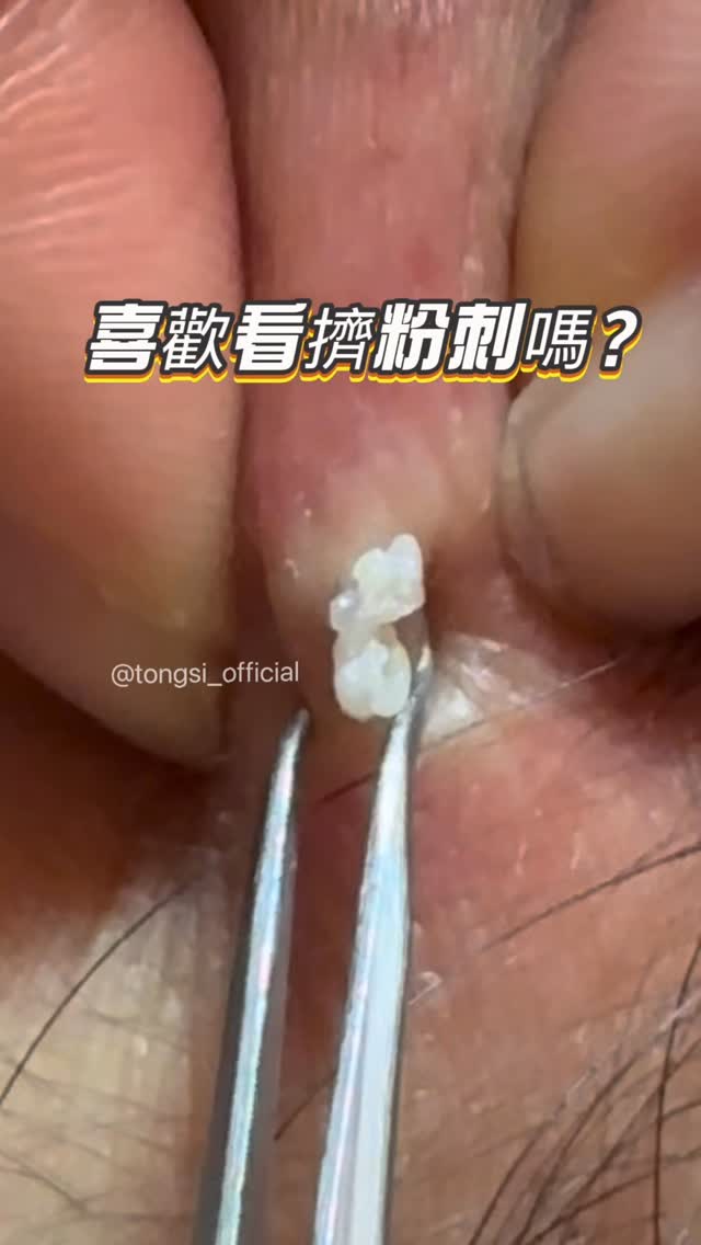 好久沒拍到完全是爆漿等級の痘💯🔥🔥🔥
有肌膚困擾歡迎來找我們 @tongsi_official 縮圖