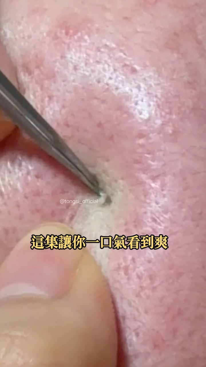 這集讓你看到爽!!
@tongsi_official 本店主打「會痛清粉刺」
會痛會乾淨 不痛不乾淨 實話豆沙包🫘🥹 縮圖