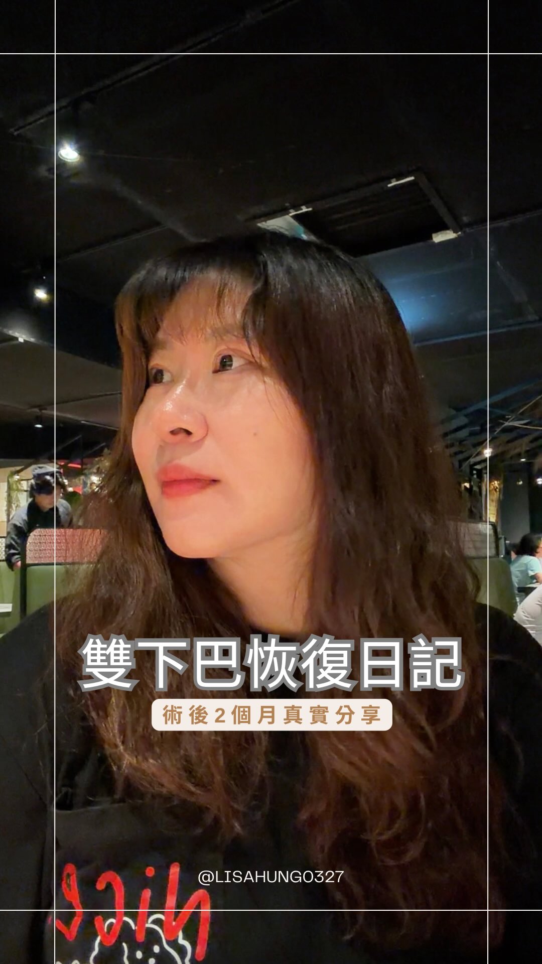 從第一個月腫到懷疑人生,到現在已經是術後第二個月😂
以前拍照還會默默找一下比較不顯雙下巴的角度,現在隨手拍、隨手錄,好像也沒那麼需要一直顧慮角度了,對我這個常常要拍影片的人來說,真的方便很多!
每個人術後的狀況和恢復過程都不一樣,術前多了解、術後給自己足夠的恢復時間,抱著「慢慢來」的心態,整個過程其實就會輕鬆很多。
我的第二個月恢復小紀錄,給大家參考,也謝謝大家一路陪我從「豬頭期」看到現在😂❤️
#雙下巴抽脂 #雙下巴 #韓國醫美 #醫美紀錄 #術後恢復 縮圖