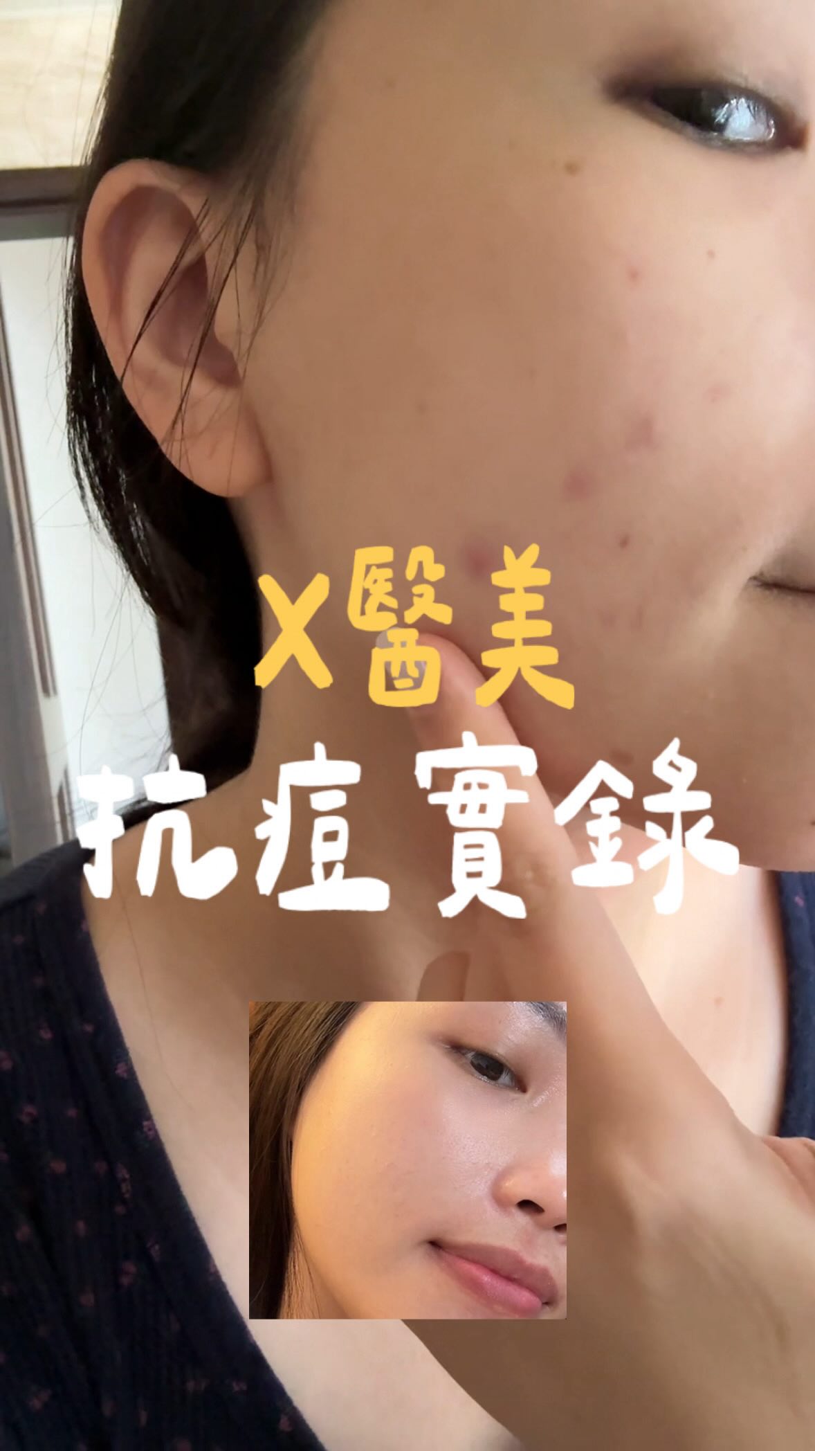 朵璽的好真的用過才知道
今年5月左右整個臉都是悶痘
埋很深而且擠不出來的那種

一時解決不了就會想用妝來遮掩
某次跟很久不久的同學約咖啡廳
回到家看照片才發現大卡粉、脫妝超丟臉⋯
鐵了心要解決臉的問題

認真擦杏仁酸1個月膚況就明顯穩定
眼下鼻翼附近、下巴的顆粒感也減少很多
現在出門都超迅速
洗臉完用爽膚棉擦拭後上防曬&潤色就結束
（早上多睡10分鐘是很珍貴的😆）
夏天女生最在意的關節處也可以擦
俗擱大碗怎麼擦都不心疼

我為了實測這幾個月都只用朵璽
途中也沒有作臉、醫美～大家可以安心參考！

8/18—8/28 朵璽首團滿千免運
下單就送「薏沛健康機能水4ml 」
有興趣可以參考精選的指南
祝福大家抗痘必勝🪖

#朵璽杏仁酸 #抗痘 縮圖