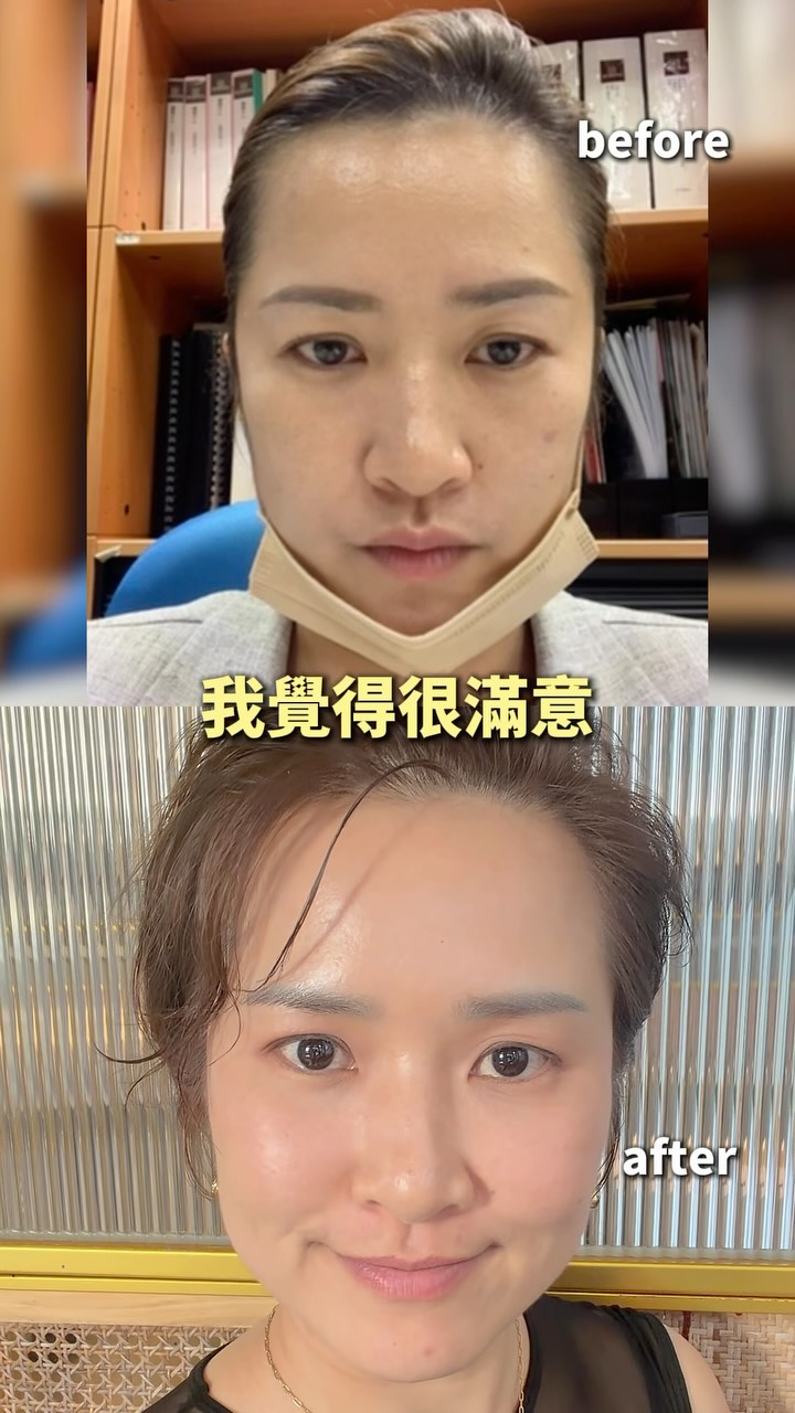 43歲第一次做醫美
直接獻給韓國釜山D-Day🤣❤️
原本只想簡單做一個項目
結果諮詢完越做越多
最後整套直接花了9萬台幣
額頭肉毒
臉頰6cc玻尿酸
完美電波+脖紋水光針
做完最喜歡的是自然又澎潤的感覺✨
環境漂亮
全程有中文翻譯
醫生也很溫柔
而且價格比台灣可愛很多
週末也有開
現在終於懂為什麼大家來韓國都要做醫美🤣
43歲了
努力賺錢也要記得讓自己越來越漂亮❤️
#韓國醫美 #釜山醫美 #Dday醫美 #韓國醫美推薦 #帆姐 縮圖